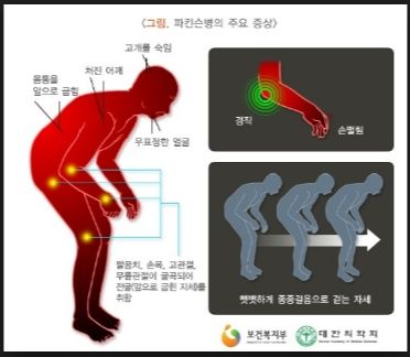 파킨슨병 증상