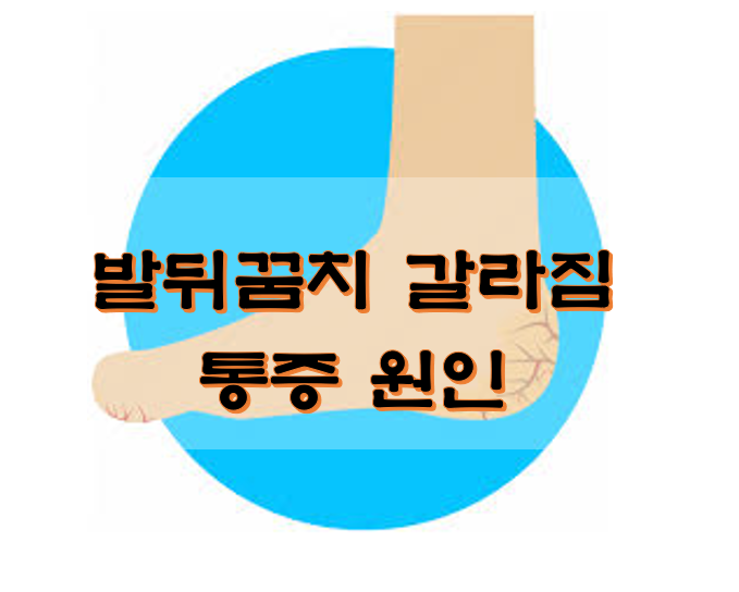  발뒤꿈치 갈라짐 통증 원인