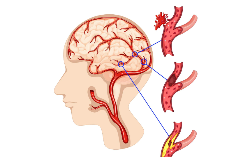 뇌동맥류(뇌꽈리)&#44; 뇌동맥류 시술&#44; 뇌동맥류 수수&#44; 뇌동맥류 개두술&#44; 뇌동맥류 코일 색전술&#44; 비파열성 뇌동맥류