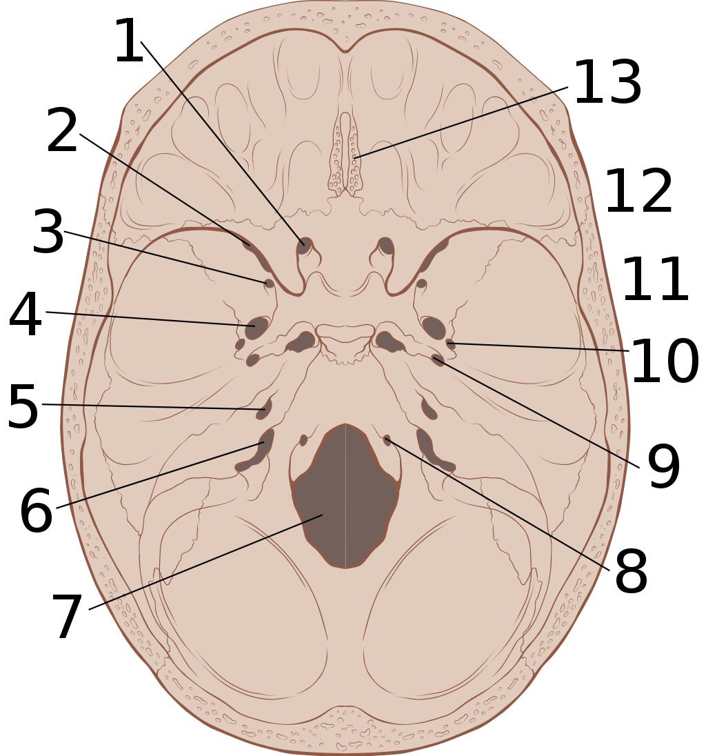 의학용어 ICH 뜻 Intracerebral hemorrhage 경막외출혈 경막밑출혈 거미막밑출혈 뇌내출혈 치료법