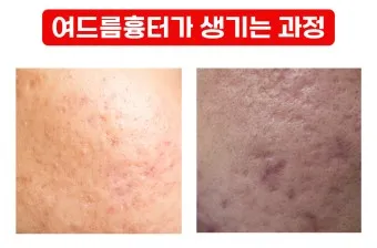 흉터전용 치료 추천 스카덤 겔 효능효과_28