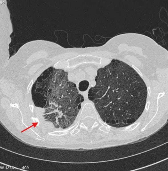 large cell carcinoma