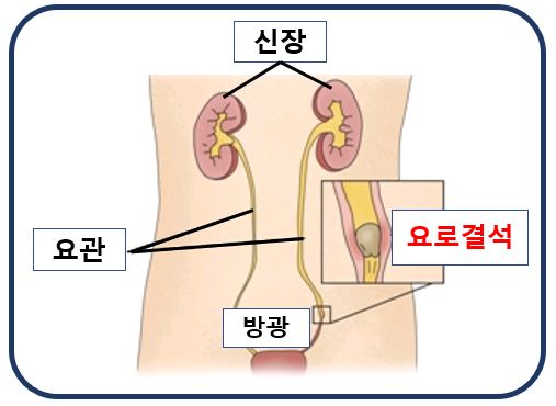 혈뇨 증상