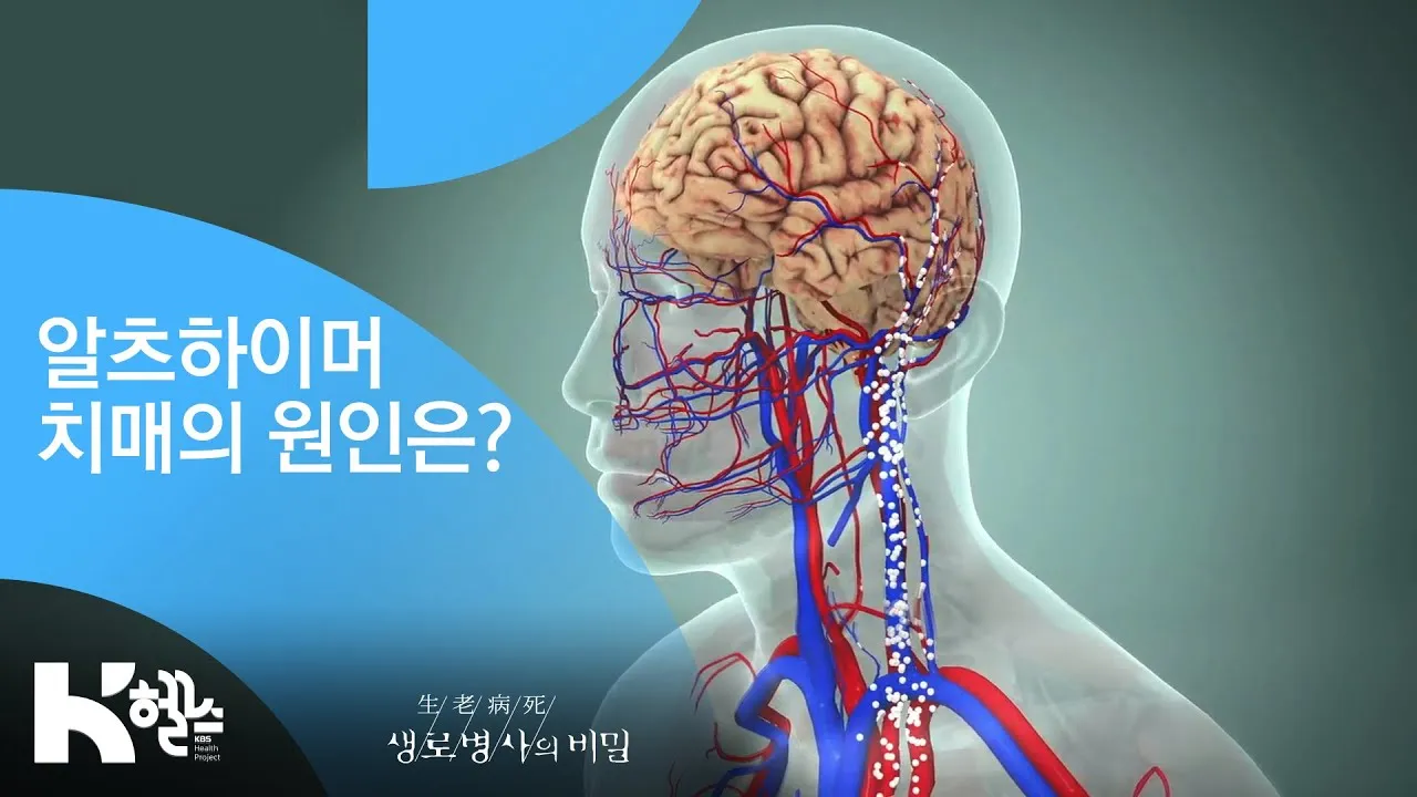 알츠하이머와 치매 차이_5