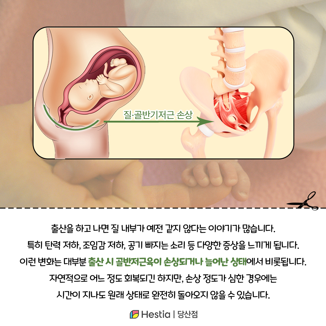 질내부늘어남, 정말 다시 되돌릴 수 있나요?