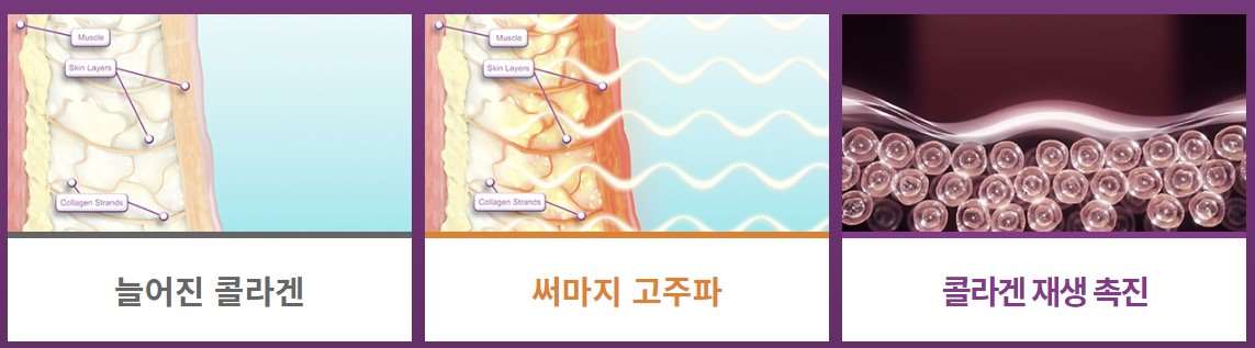  4세대 써마지FLX 원리와 통증 등 전반적으로 알아보기