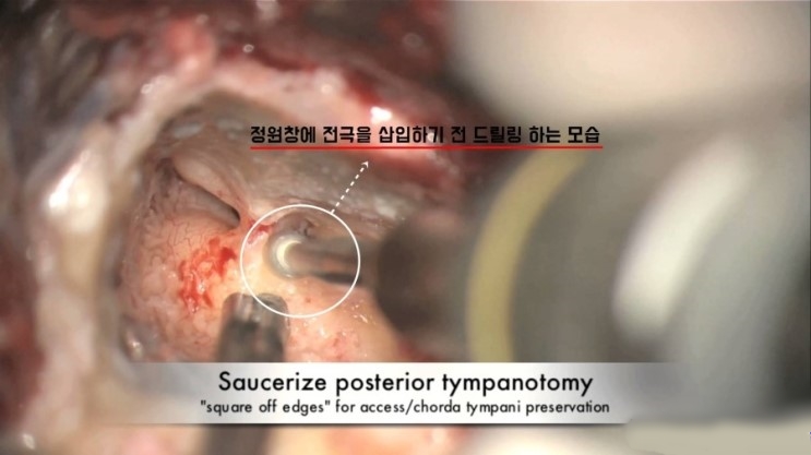  [인공와우] 치매위험 높이는 노인성난청, 보청기로 효과 없을시 수술해야