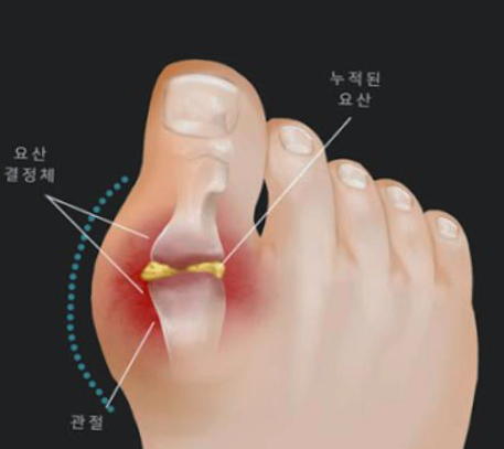  통풍 제대로 알려면 여기로!