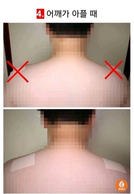 "파스는 이곳에 붙이는 겁니다" 국민 대부분 잘못 알고 있는 파스 부착방법