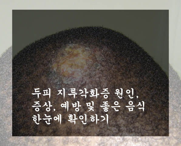  두피 지루각화증 원인, 증상, 예방 및 좋은 음식 한눈에 확인하기