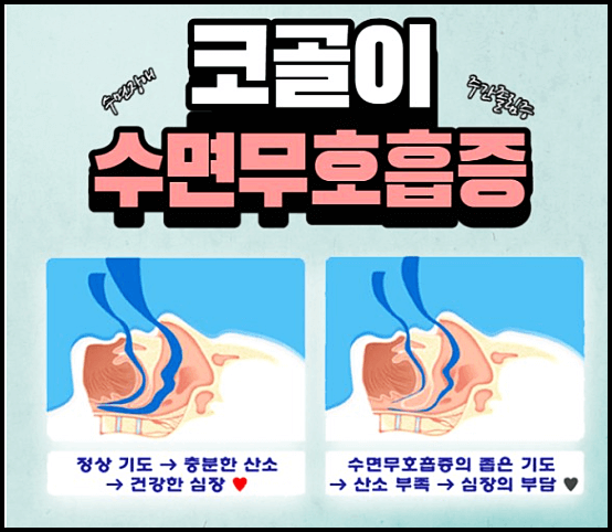 코골이 수면무호흡증