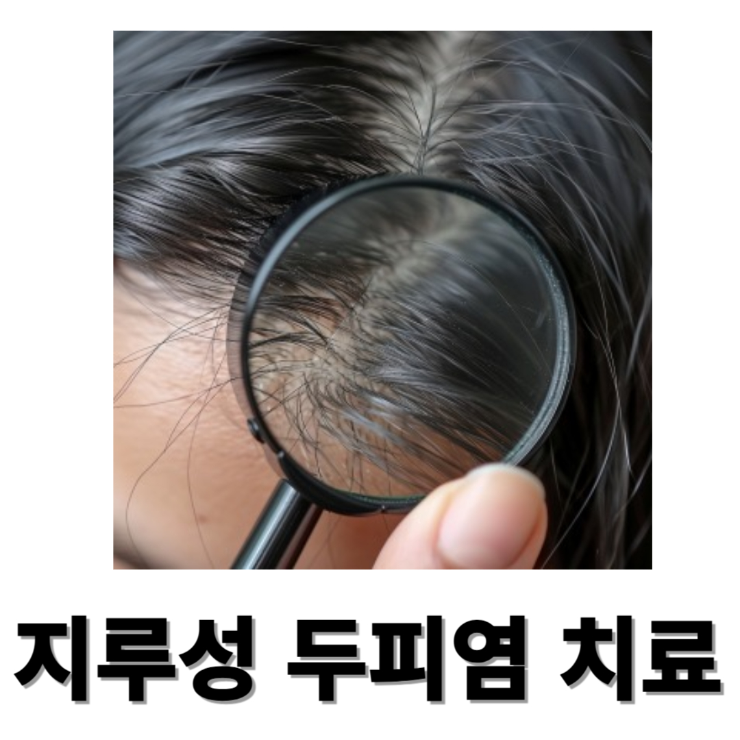 지루성두피염과 관련된 사진입니다.