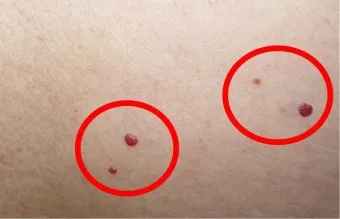 몸에 점이 계속 생기는 이유 원인부터 예방법까지 한눈에_24