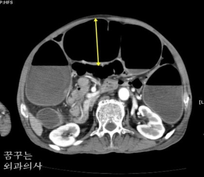 가성장폐색