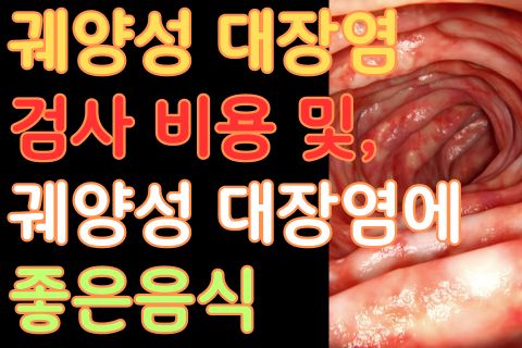 궤양성 대장염 검사 비용 및&#44; 궤양성 대장염에 좋은음식