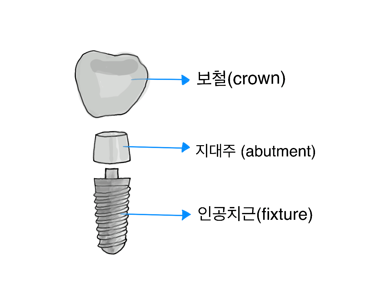 임플란트 구조