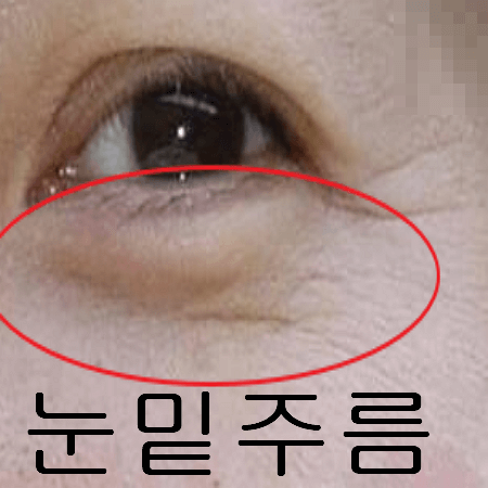 눈밑 주름이 심한 여성