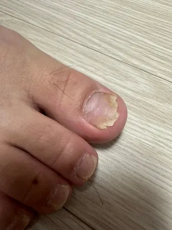 라셀턴 사용법과 가격 비교 발톱앰플 후기 정리해보기_22