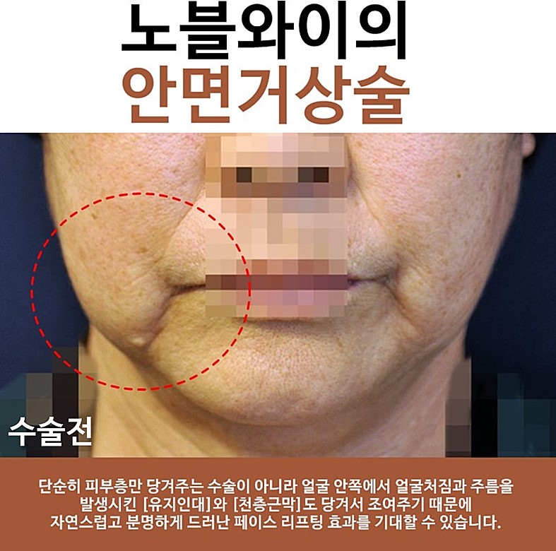  안면거상 유지기간 5년 이상이 맞는지