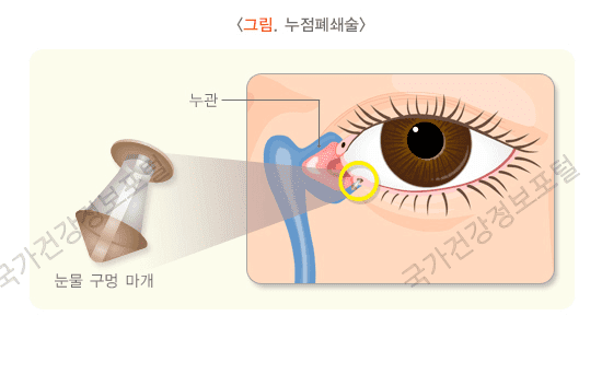 누점 폐쇄술 (출처 : 질병관리청 국가건강정보포털)