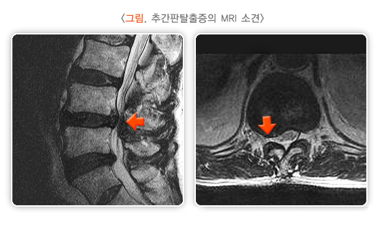  추간판탈출증(디스크) 증상과 치료 방법