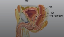 전립선비대증 치료와 좋은음식 총정리