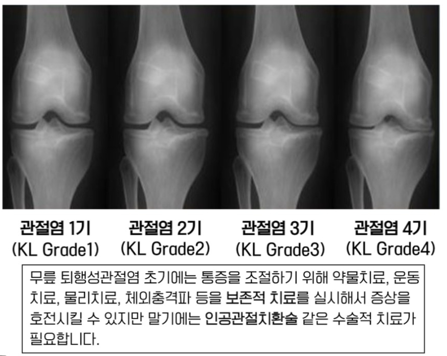 무릎통증 원인