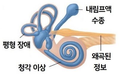 이석증 원인