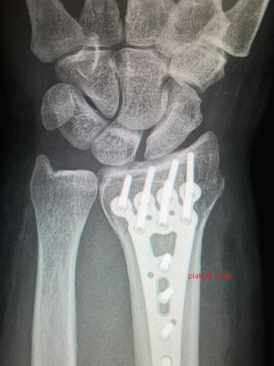 손목 골절 시 plate를 이용한 손목 x-ray 사진