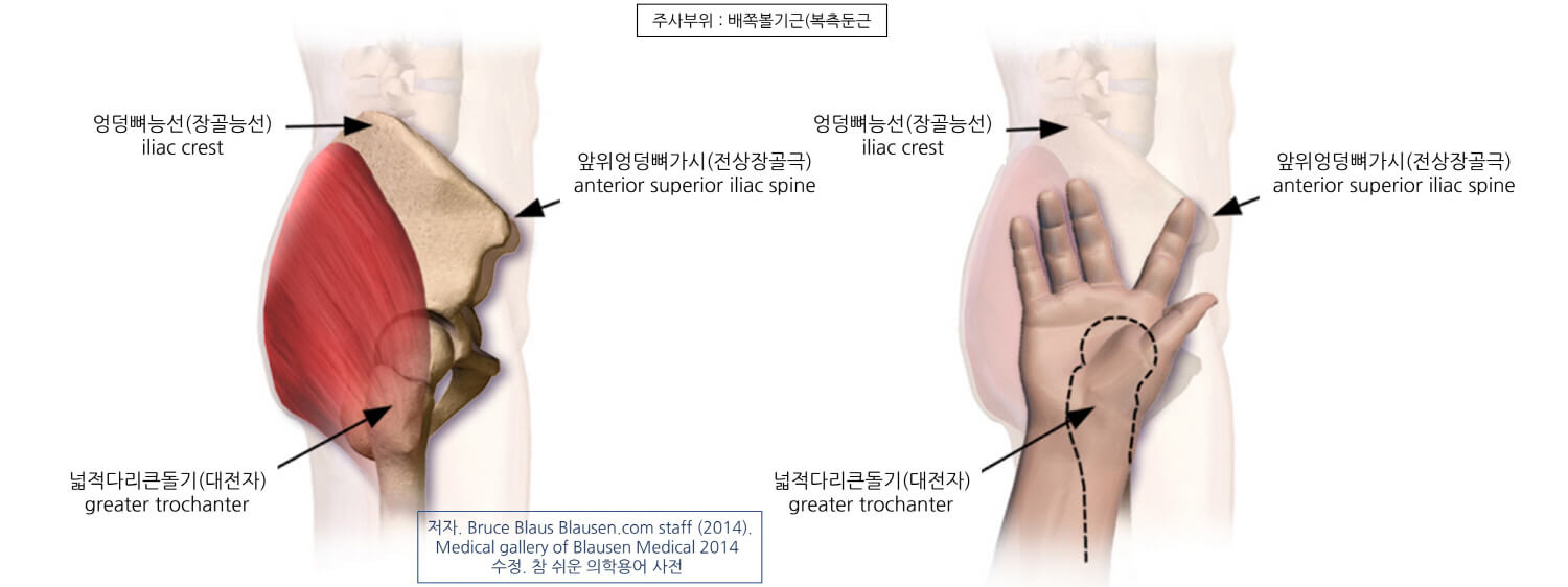 의학용어 IM injection 뜻 근육주사 부위, 근육주사 핵심술기