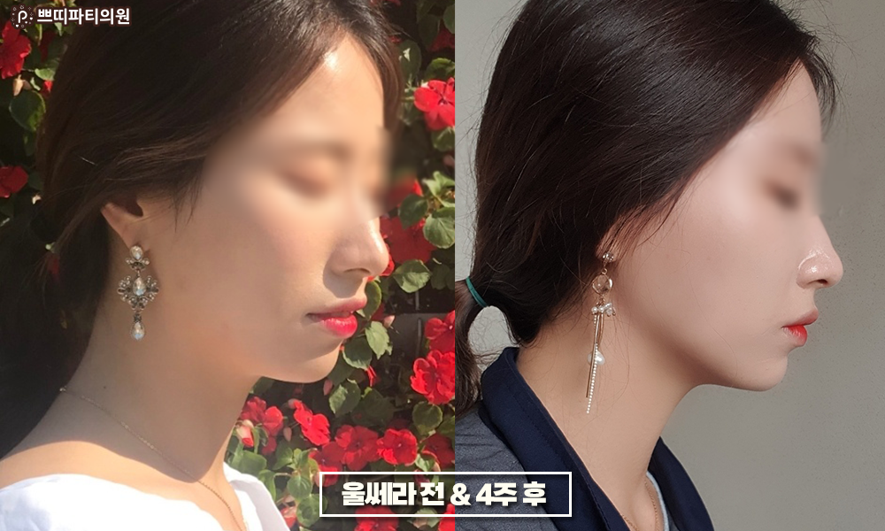  울쎄라리프팅 초음파리프팅을 찾는 이유! 탄력변화 후기!