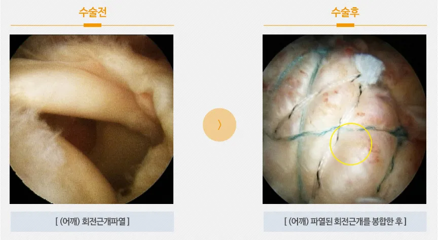 회전근개파열 수술후 회복기간