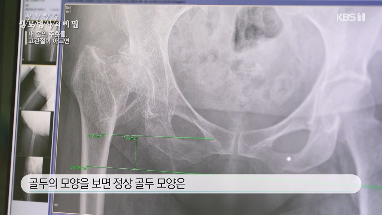 생로병사의 비밀.E890.231116p-NEXT.mp4_20231116_204854.703.jpg