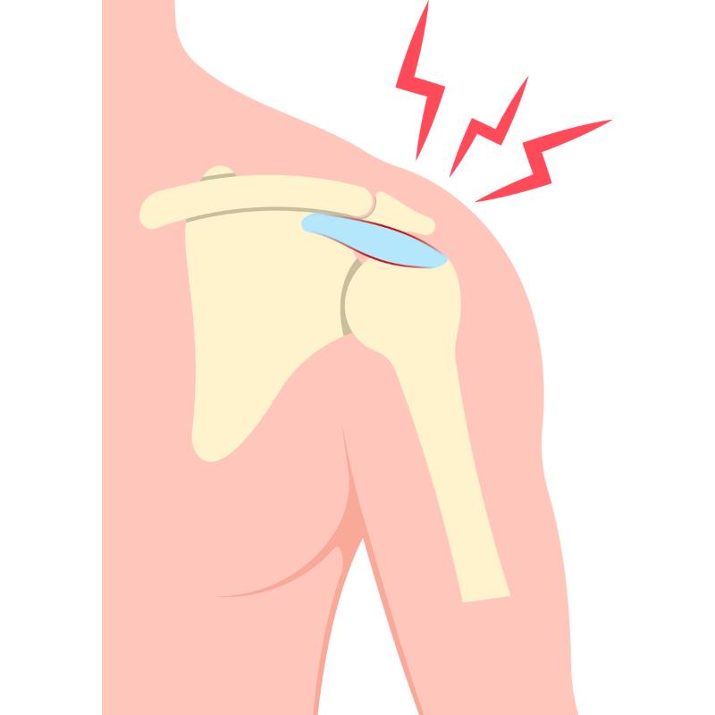 어깨 충돌 증후군 원인
