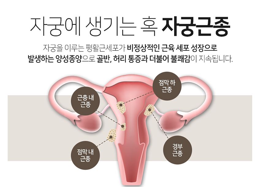 자궁근종 증상·원인·치료 / 자가진단 체크리스트