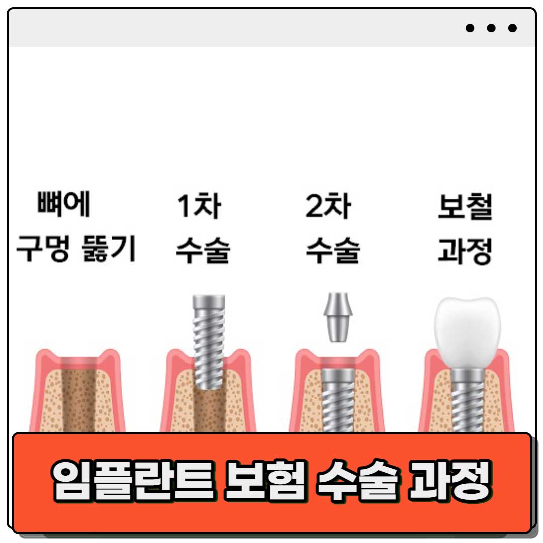 임플란트-의료보험-적용-나이-만-65세-이상-혜택