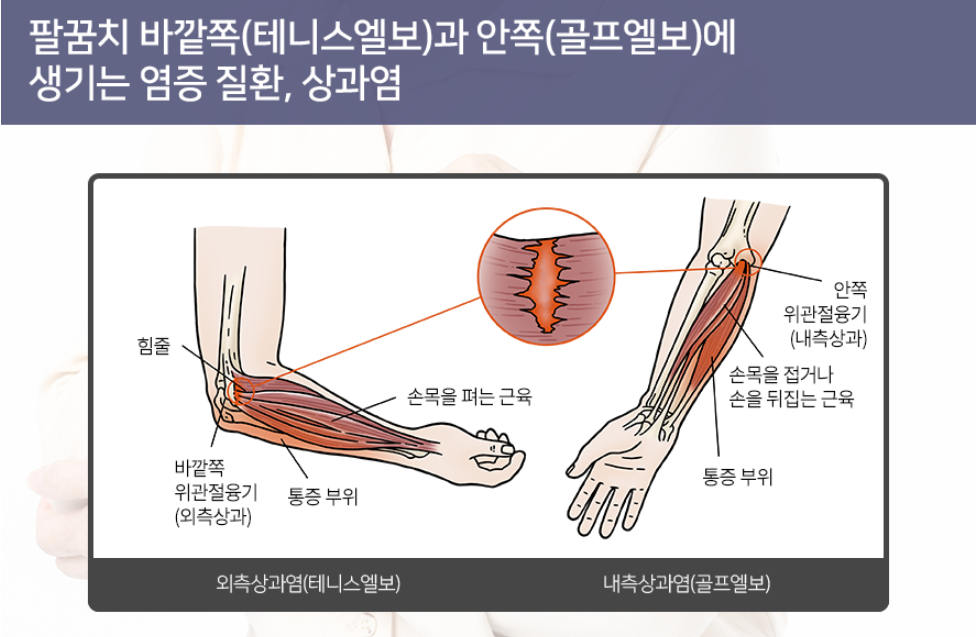 테니스엘보우와 골프엘보우