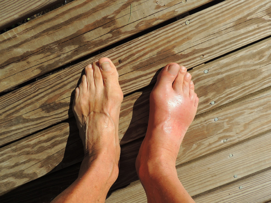 통풍을 앓고 있는 환자가 본인의 발을 위에서 봤을 때&#44; 오른쪽 발등이 왼쪽 발등에 비해 염증으로 인해 많이 부어 있는 것을 찍은 사진