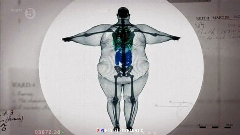 몸무게 400kg 남자의 엑스레이 사진