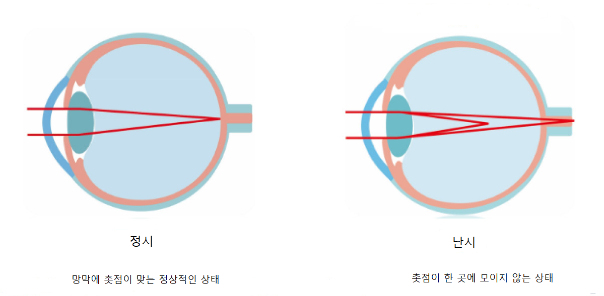 정시와 난시