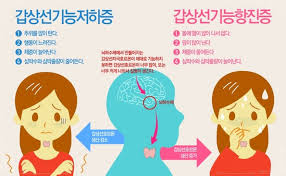 갑상선 기능 저하증