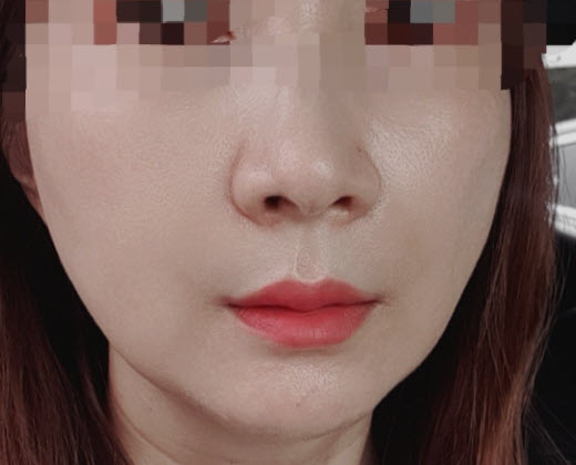 귀족수술 원숭이상