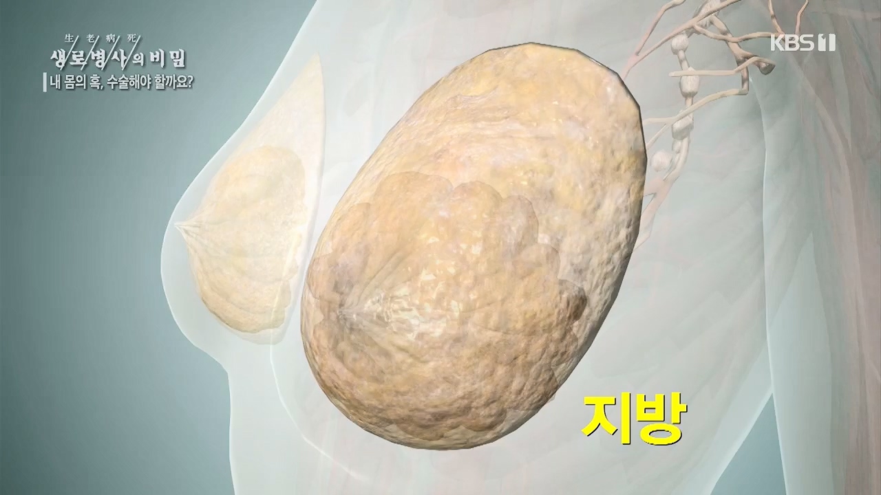 생로병사의 비밀.E870.230532p.H264-F1RST.mp4_20230605_201517.274.jpg
