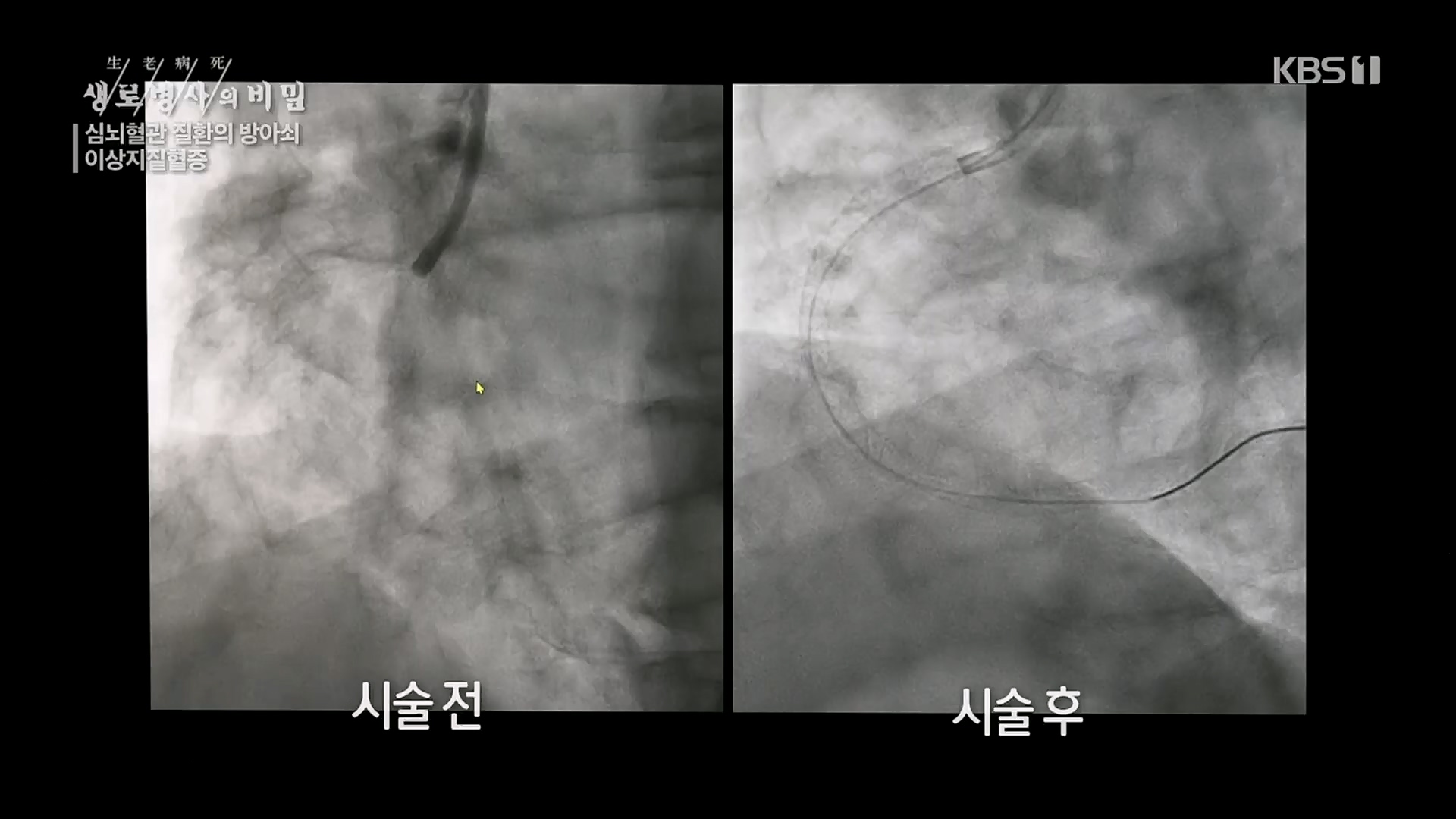 생로병사의 비밀.E862.230329p.H264-F1RST.mp4_20230330_203220.072.jpg