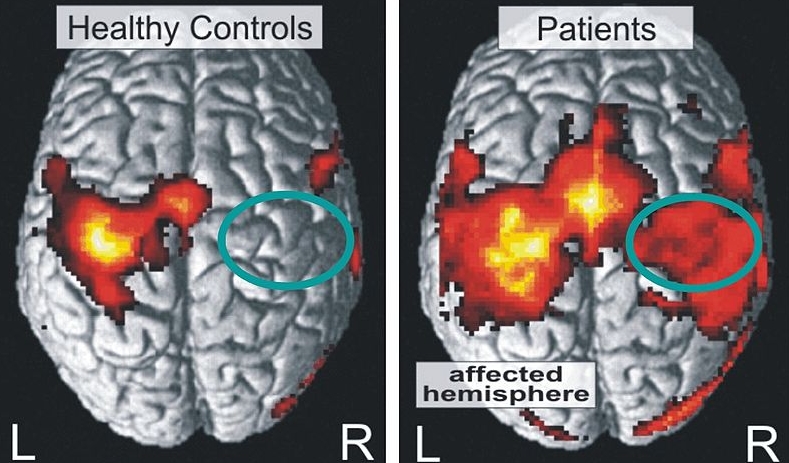 뇌졸중&amp;#44; 뇌출혈&amp;#44; 뇌경색의 차이점2
