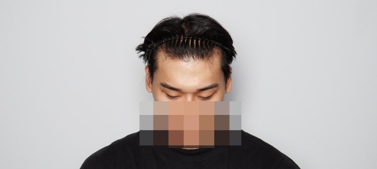 중앙헤어라인 이미지