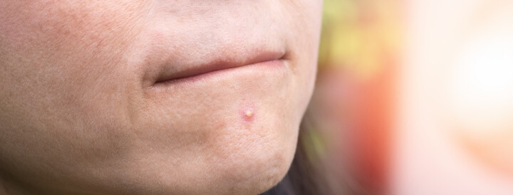 안면 모낭염의 원인 해결 12