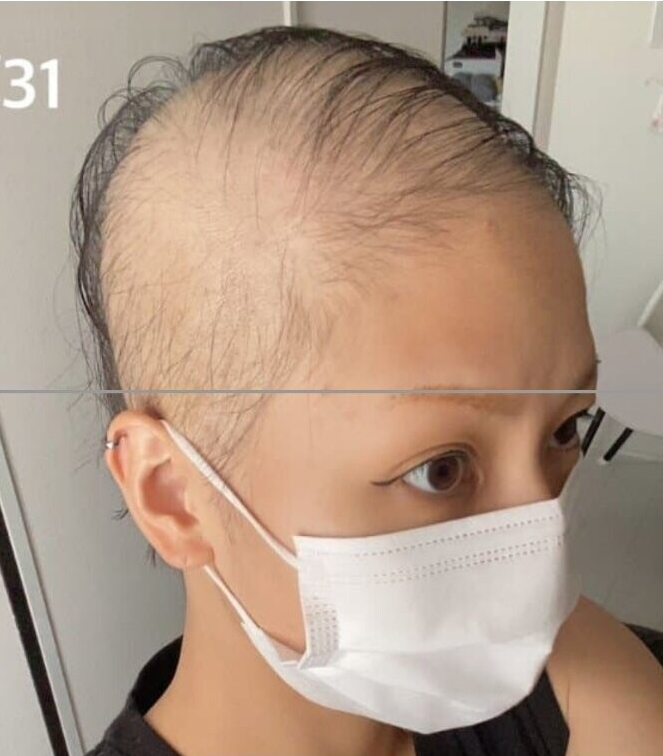  모더나 맞고 탈모 왔다는 일본 여자