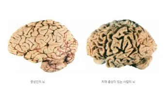 알츠하이머와 치매 차이_23
