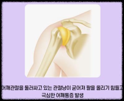  오십견 어깨가 왜이리 아프지?